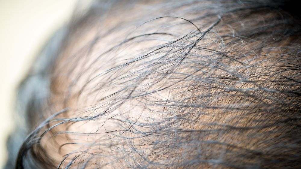 Early Signs of Hair Loss: Causes & Prevention