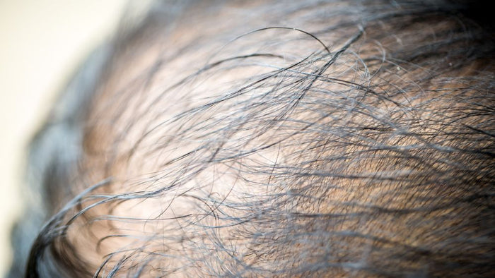 Early Signs of Hair Loss: Causes & Prevention