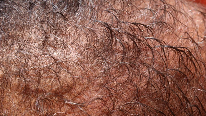 Natural DHT Blockers for Women: Boost Hair Growth Naturally