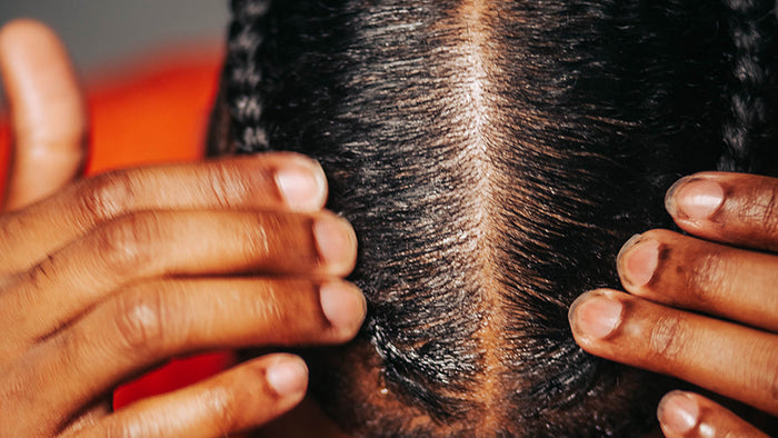 Does Keto Cause Hair Loss?