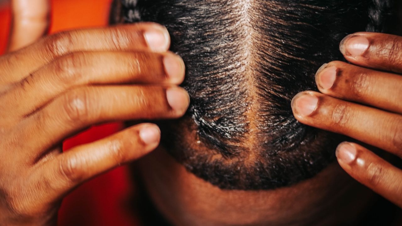 The 4 Most Overlooked Reasons Why Your Hairline is Thinning