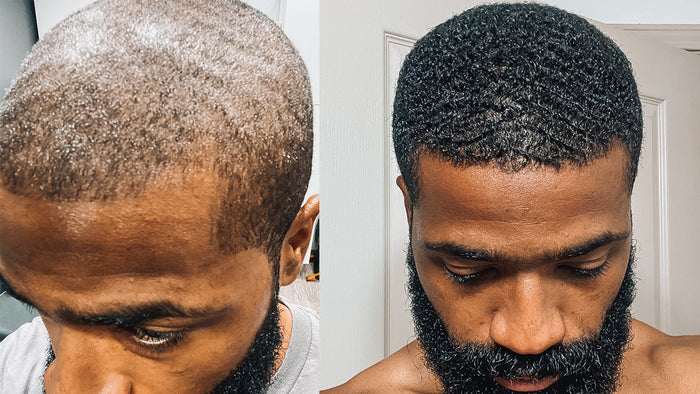 What I learned from my hair loss journey