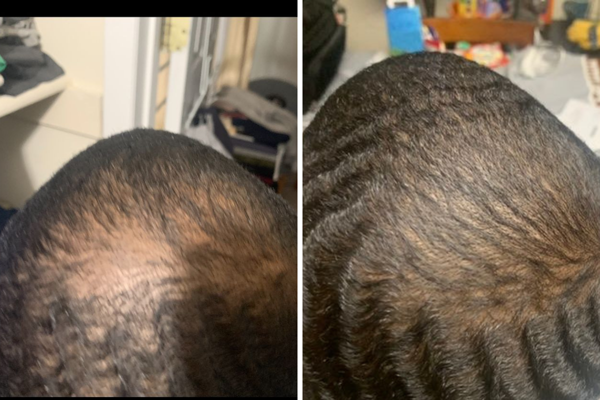 90-Day Hair Recovery Blueprint