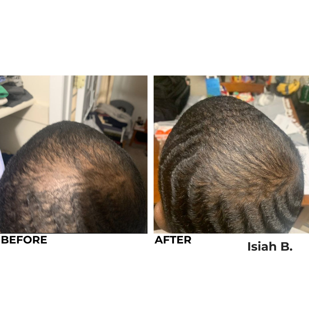 MY Hair Activation Elite System