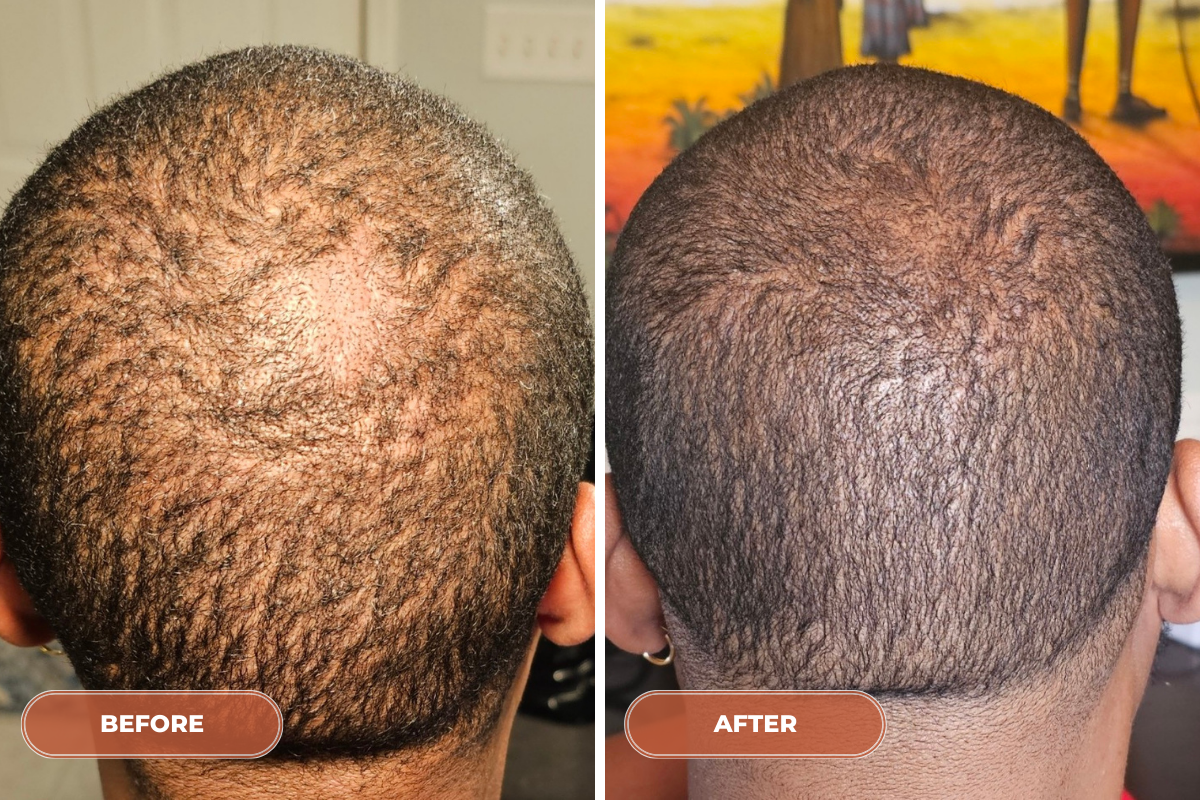 12 Month Hair Rebuild System - Monthly