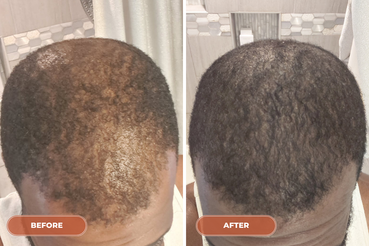 12 Month Hair Rebuild System - Monthly
